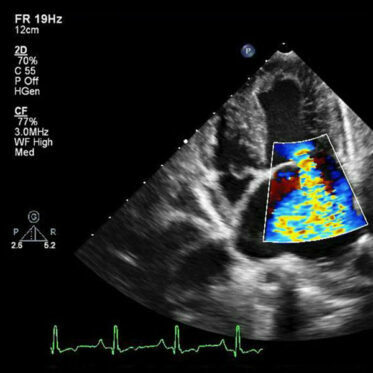 echo-serca-1 Echo serca - obrazek 1